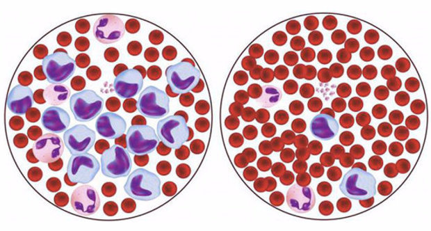 Моноцитов 8 в общем анализе крови что это